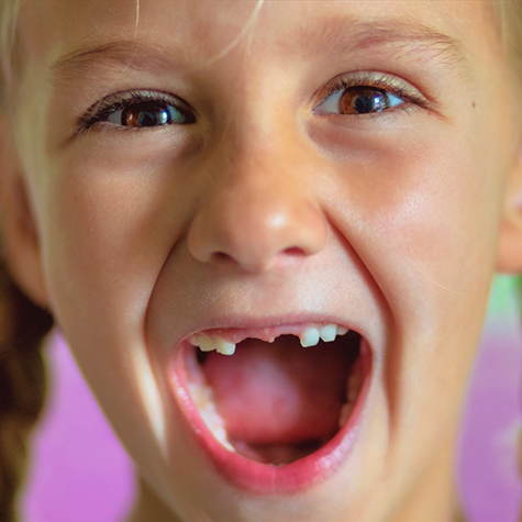 Child grinning wide with their two front teeth missing