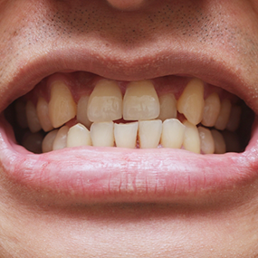 Close up of a mouth with crowded teeth