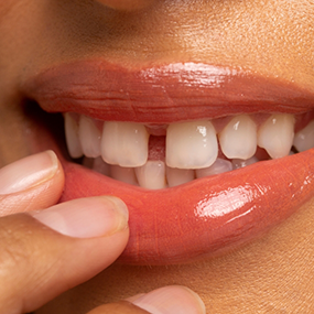 Close up of a mouth with small gaps between some of the teeth