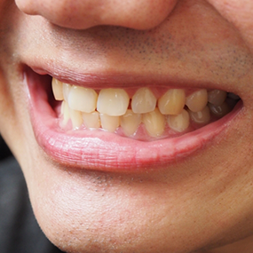 Close up of a mouth with a slight overbite