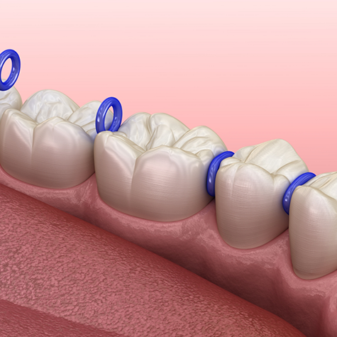 Illustration of small circular bands placed between each tooth