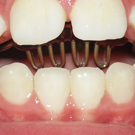 Close up of a small metal crib-like device in the mouth