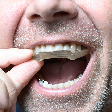 Man placing a plate over his teeth