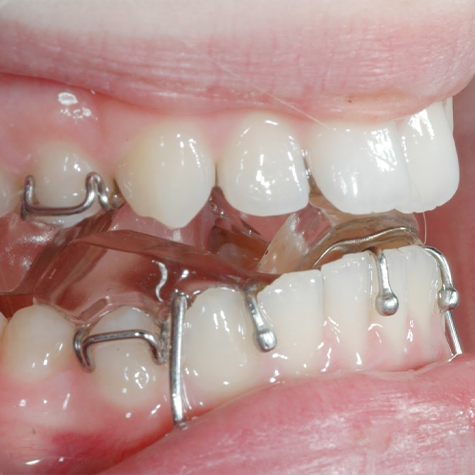 Close up of a mouth with a metal appliance on the lower teeth