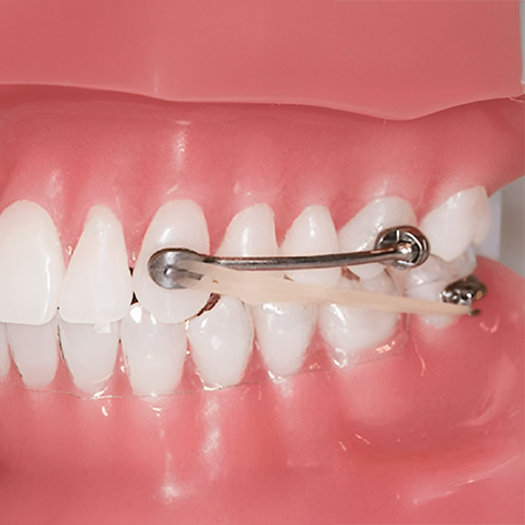 Small metal rod with a rubber band attached to the teeth