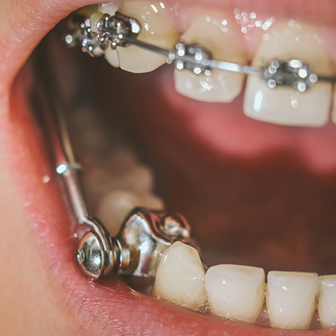 Close up of a mouth with a metal appliance for correcting an overbite