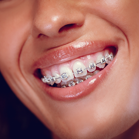 Close up of a smile with braces