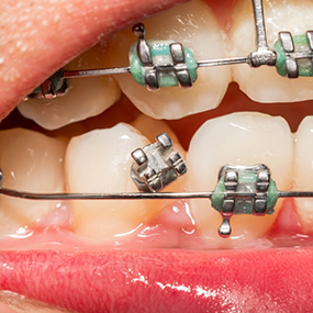 Close up of a braces brakcet that has broken off